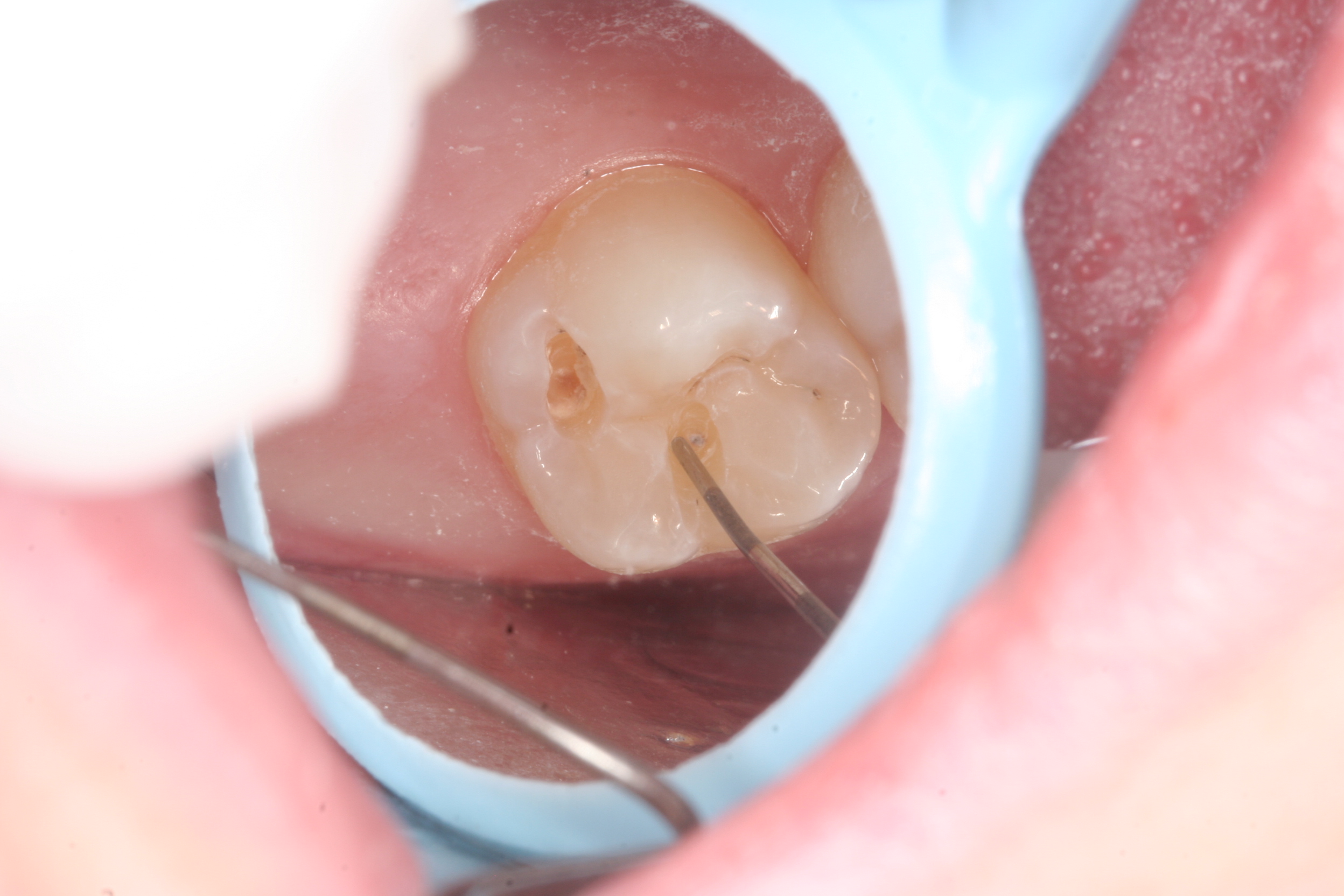 Index Of images concerns small Cavity